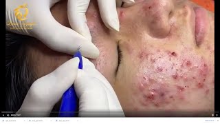 Treatment of acne tablets pustules and blackheads 359  Loan Nguyen [upl. by Jammal]