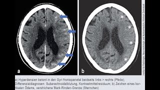 Kontrastmittelinduzierte Enzephalopathie [upl. by Therine]