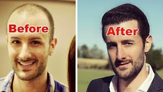 How Many Hair Transplant GRAFTS Do You Need To Achieve Density [upl. by Anoblav]