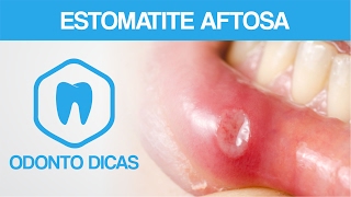 ESTOMATITE AFTOSA  ODONTO DICAS [upl. by Enellek]