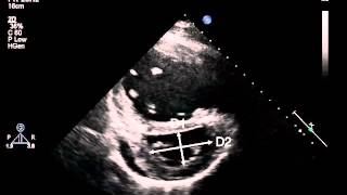 7B Parasternal short axis of the LV at the papillary muscle for LV eccentricity index PH [upl. by Neelhtak711]