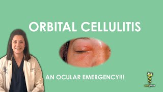 Orbital Cellulitis an ocular emergency [upl. by Chrystal]