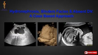 Hydronephrosis Binders Facies and Absent DV A Case Based Approach [upl. by Leon]