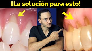 Retracción de encía y Desgaste en cuello de los dientes ¿Cómo se soluciona y qué lo provoca [upl. by Ardis330]