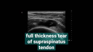 Full thickness tear of supraspinatus tendon Supraspinatus tendonunda tam kat yırtık [upl. by Ibrab411]