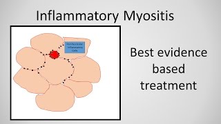 Myositis Inflammatory Myopathy Treatment [upl. by Octavus]