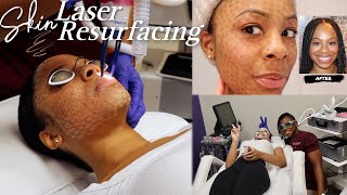 LASER SKIN RESURFACING  What To Expect Peeling Process And Final Results  Aerolase Era Elite [upl. by Oicangi]