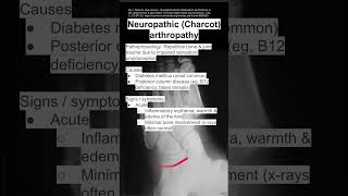 Neuropathic Charcot arthropathy [upl. by Hildagarde705]