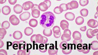 Peripheral smear examination  Peripheral blood smear  Malaria blood smear  Malaria parasite [upl. by Ellwood]