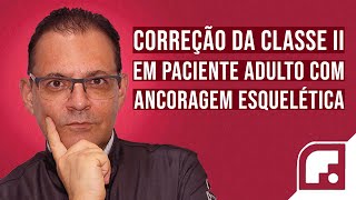 CORREÇÃO DA CLASSE II EM PACIENTE ADULTO COM ANCORAGEM ESQUELÉTICA [upl. by Tessy94]