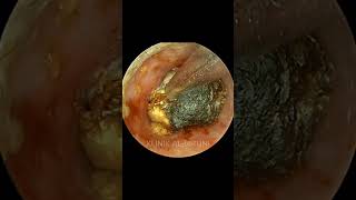 COMPLETE Package Of Earwax With Fungi [upl. by Syah]