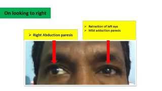 Duanes Retraction Syndrome [upl. by Henricks]