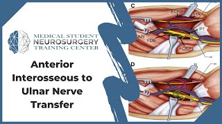 Anterior Interosseous to Ulnar Nerve Transfer [upl. by Llenra]