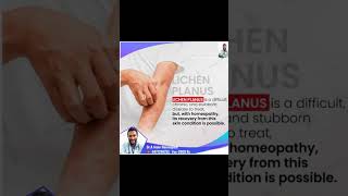 Lichen Planus treatment [upl. by Atiraj]