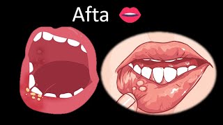 👄 Aftas  Cavidad oral  Cabeza y Cuello  Patología [upl. by Elrae]