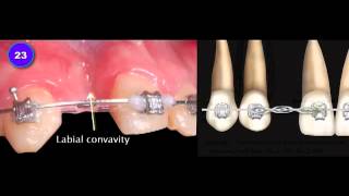 V5 iAOI Case 5 Report by Dr Lee Congenital Missing Teeth with a Unilateral Crossbite [upl. by Tchao]