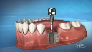 Clínica de implantes dentales en BogotáMarlon Becerra Niza [upl. by Noguchi]