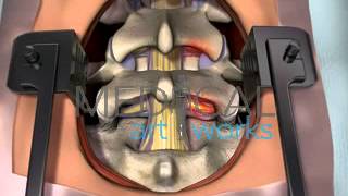 3D Medical Animation  Lumbar spine surgical procedure 2 level fusion of L4S1 [upl. by Akiraa]