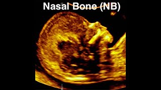 Nasal bone assessment and absent nasal bone at 1113 weeks [upl. by Spillar557]