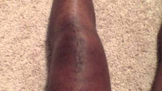 Week 3 Of Recovery of Ruptured Patella Knee Tendon [upl. by Figge]