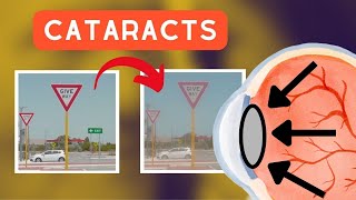 What CATARACTS do to your vision [upl. by Eedebez]