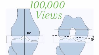 Total Knee Replacement Step by Step [upl. by Anafetse964]