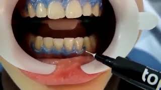 FGM Whiteness HP Maxx For Bleaching amp Tooth Whitening  How To Use  DENTBEAR [upl. by Sewellyn149]