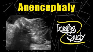 Fetal Anencephaly  Neural Tube Defect  Ultrasound  Case 109 [upl. by Beebe]