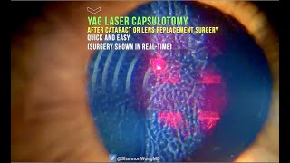 Everything you need to know about YAG LASER Capsulotomy in 30 seconds [upl. by Stromberg]