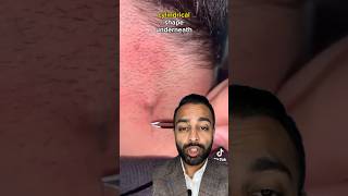 Ingrown Hair Extraction  Dr Somji Reacts [upl. by Barbour]