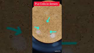 Semen examination under microscopeWBCsWhite Blood cells spermatozoasperm [upl. by Kcub136]