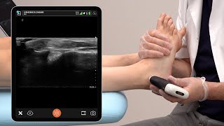 Ultrasound of the Lateral Ankle Ligaments [upl. by Ainuj]