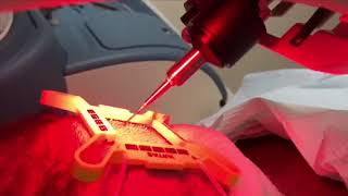 LIVE ARTAS Robotic Hair Transplant Procedure  ARTAS in Action [upl. by Shaw935]