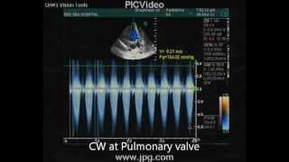 echocardiogram of severe pulmonary stenosis [upl. by Sahc825]