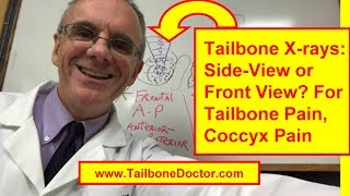 Coccyx Xrays Sideview vs Frontview for Tailbone Pain Coccyx Pain [upl. by Halimaj]