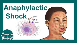 Anaphylactic shock  Anaphylactic Reaction Symptoms and Treatment [upl. by Llebpmac]