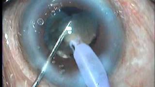 Hard brown cataractstop ampchop  Ozil infinity Dr Sajid Ahmed [upl. by Verne]