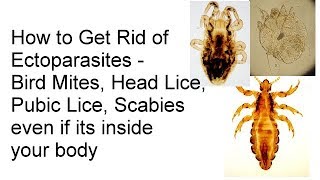 How to Get Rid of Lice Pubic Lice Scabies Bird Mites Ectoparasites even if its inside your body [upl. by Hammer]