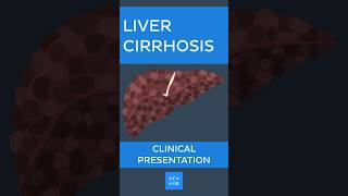 Liver cirrhosis Clinical presentation  Kenhub livercirrhosis [upl. by Kerk]