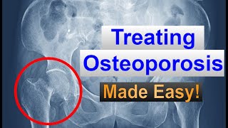 OSTEOPOROSIS Medications Made EASY [upl. by Orr]