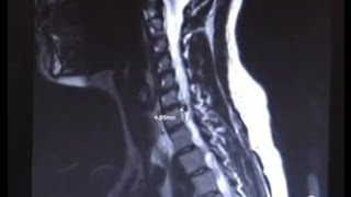 Cervical Spine Fusion with Neurosurgeon Dr Alok Chaudhari [upl. by Artapoelc]