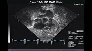 P395 Case 183 Pulmonary Stenosis with infundibular stenosis [upl. by Mylander]