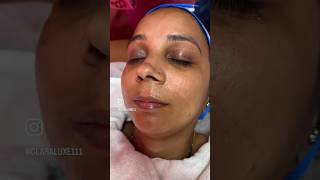 Acne peel session viralvideo youtubeshorts peels peeling acnetreatment acnetreatment [upl. by Enial]