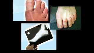 How to Fix Hammer Toe On Children [upl. by Elesig]