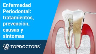 Enfermedad Periodontal tratamientos prevención causas y síntomas [upl. by Yvel]