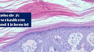 Episode 2 Psoriasiform and Lichenoid [upl. by Alekal]