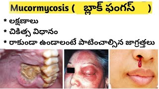 Black Fungal Infection in Covid  MucormycosisZygomycosis in Telugu [upl. by Maurizio218]