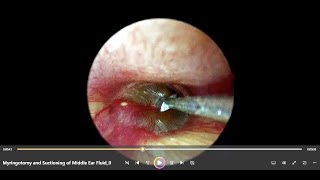 Myringotomy and Suctioning of Middle Ear Fluid In Acute Otitis Media [upl. by Ahseenat]