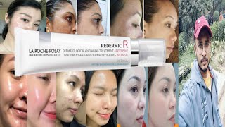 la roche posay redermic r retinol cream  honest review [upl. by Elberta]