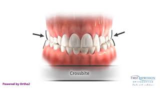 Correcting Posterior Crossbites [upl. by Chanda]